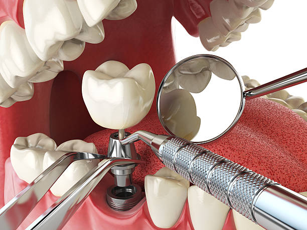 Best Broken or Chipped Tooth Repair in Ottawa, OH
